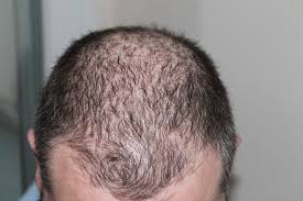 caida cabello